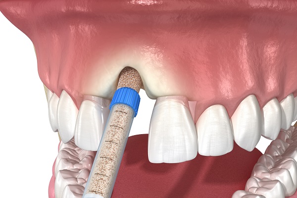 Pros And Cons Of Bone Grafting